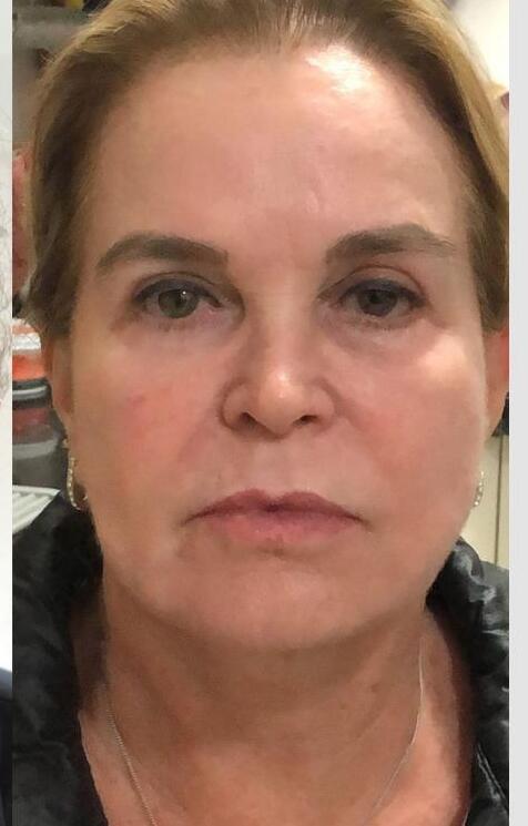 Ana — depois do uso do Skin Pause