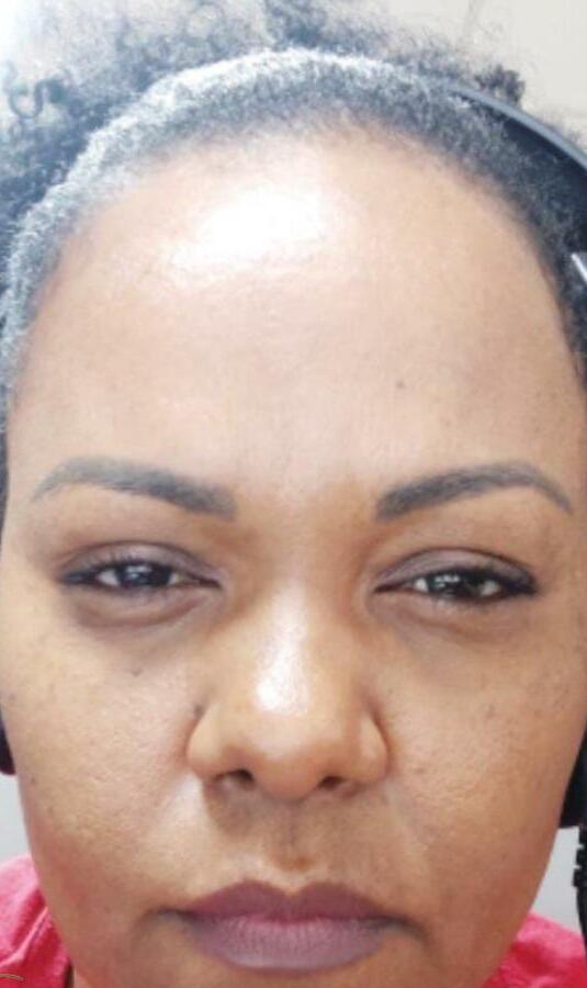 Lúcia — depois do uso do Skin Pause