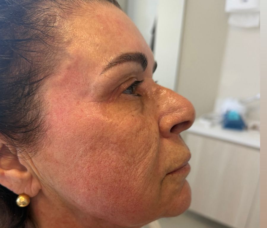 Sônia — antes do uso do Skin Pause